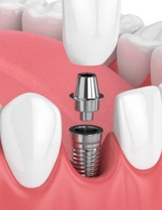 dental implants