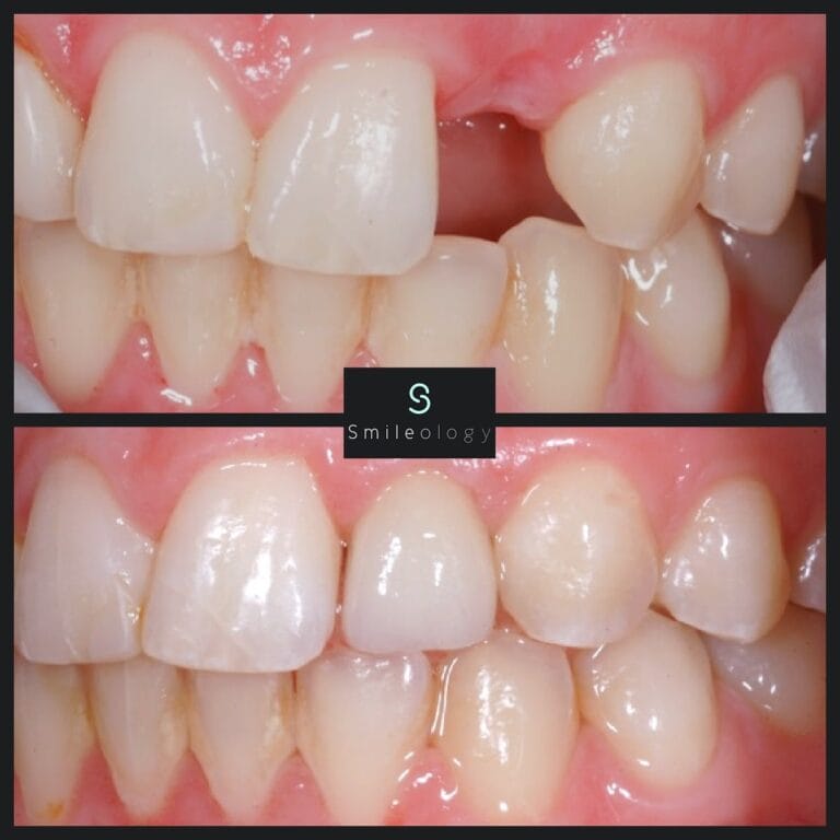 Central Incisors copy min