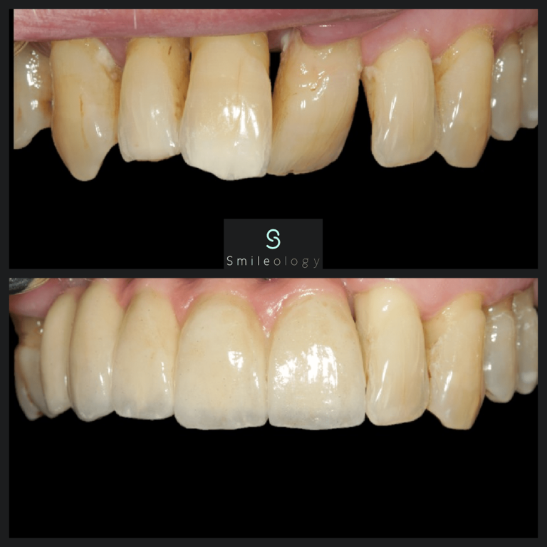 MA Implant Bridge min