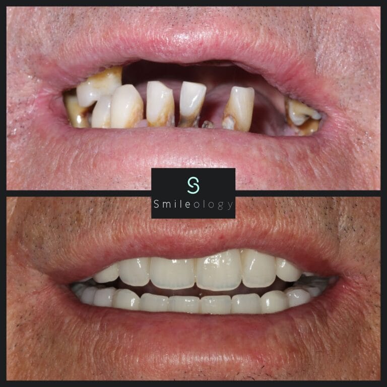 Overdenture 1 min