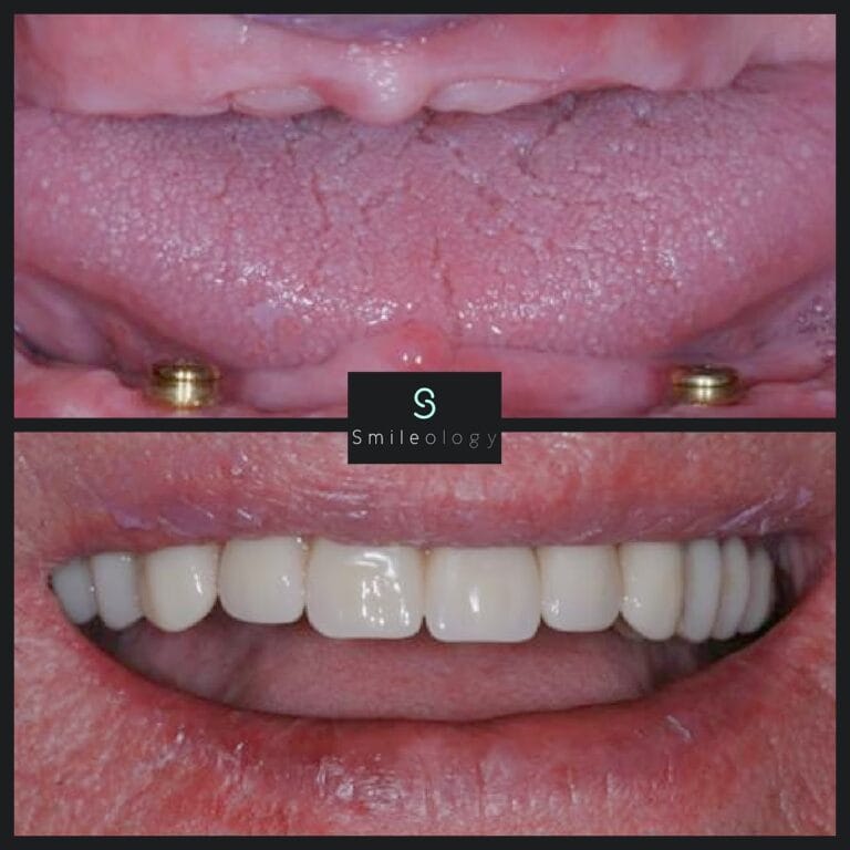 Overdenture min