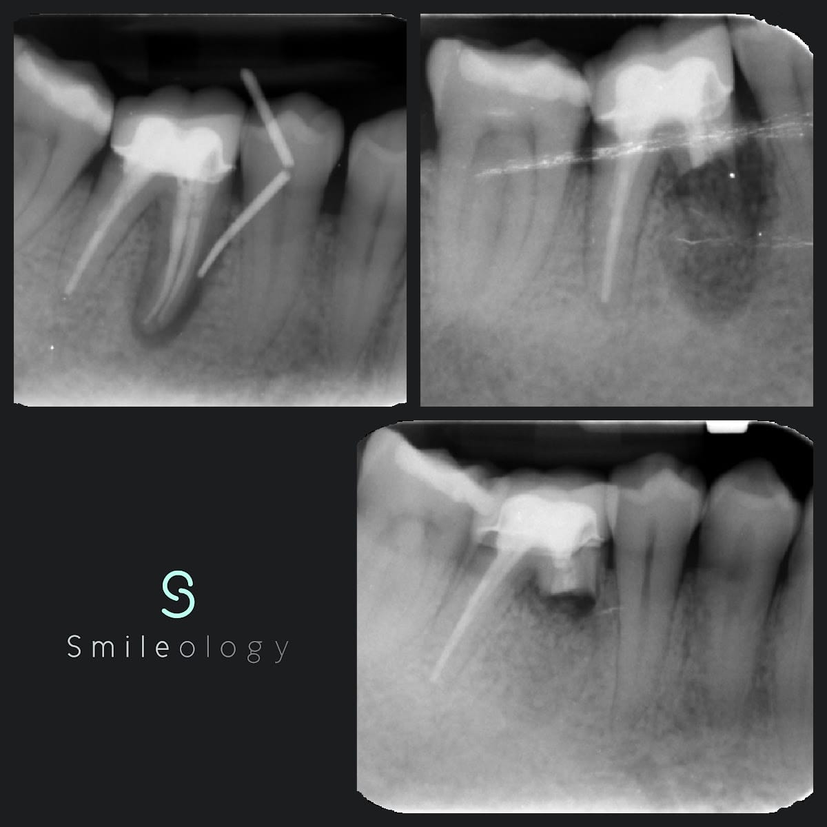 Smile Gallery - Endodontics - Smileology in Rochester and Maidstone, Kent