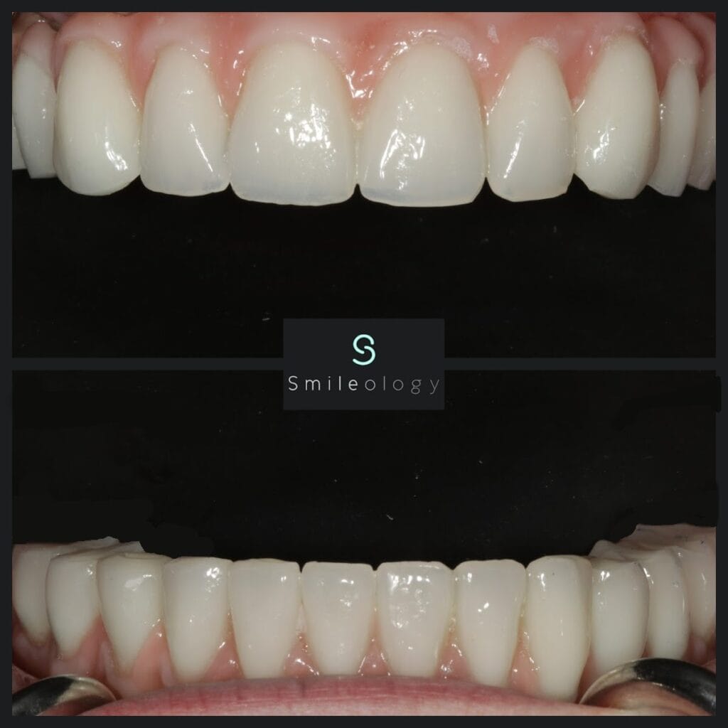 TB Implant Bridge min