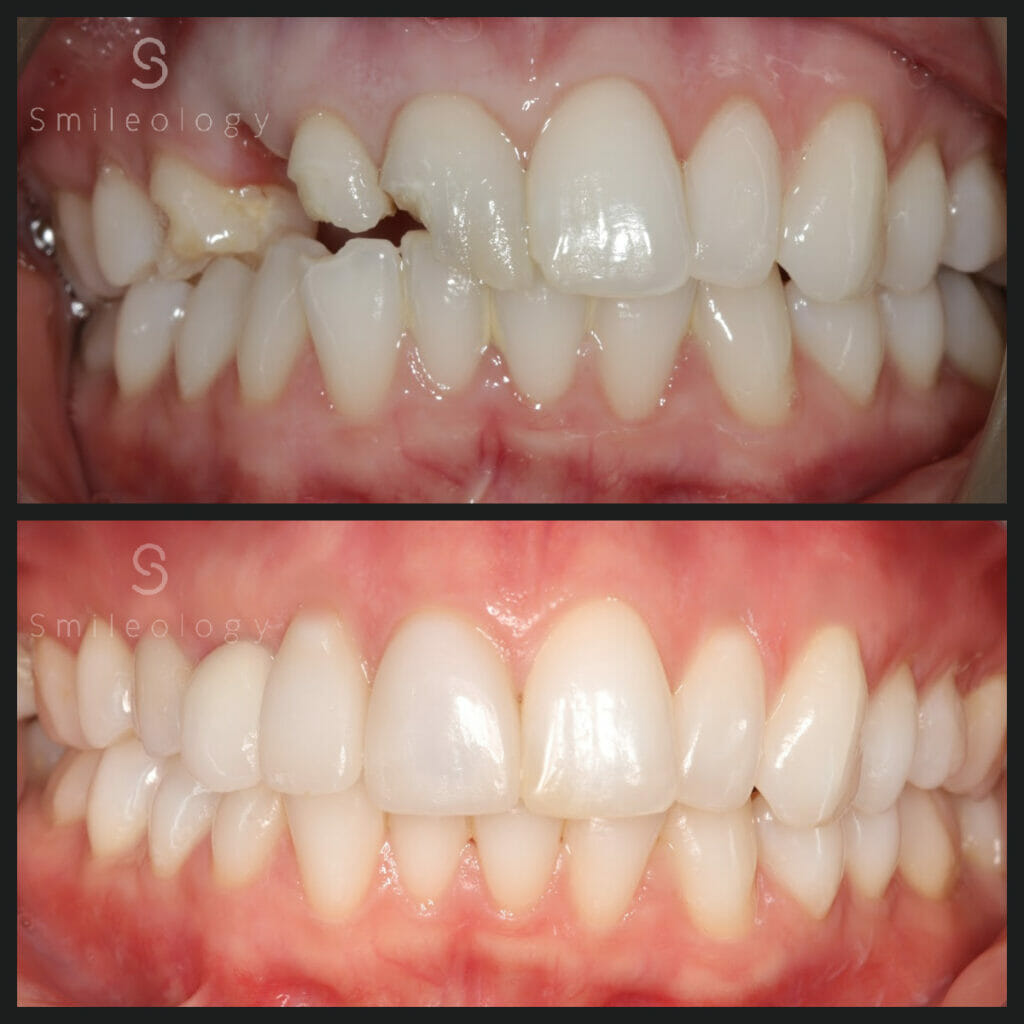 SW Single Implant