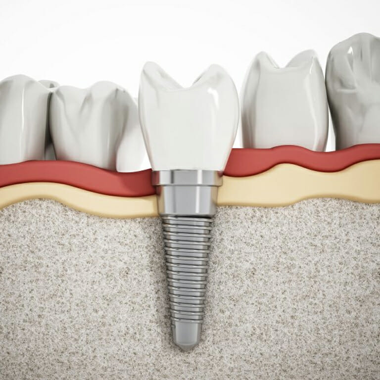 dental implants in the kent tooth 
Candidate for dental implants