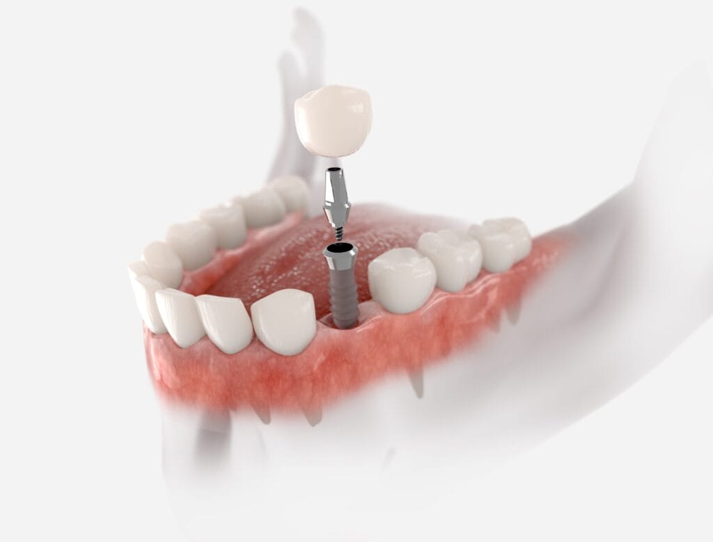full mouth dental implants full arch dental implants near me