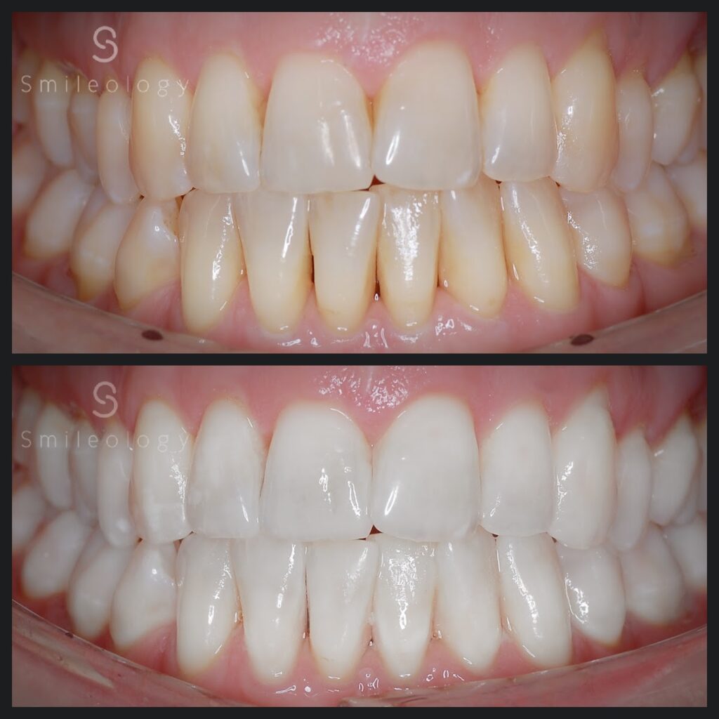 AP Whitening