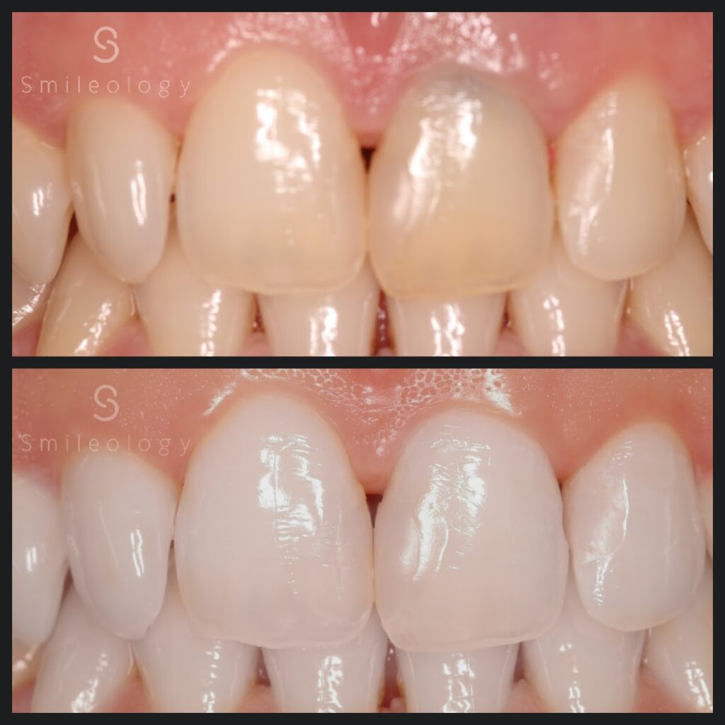 Nimara internal bleaching copy