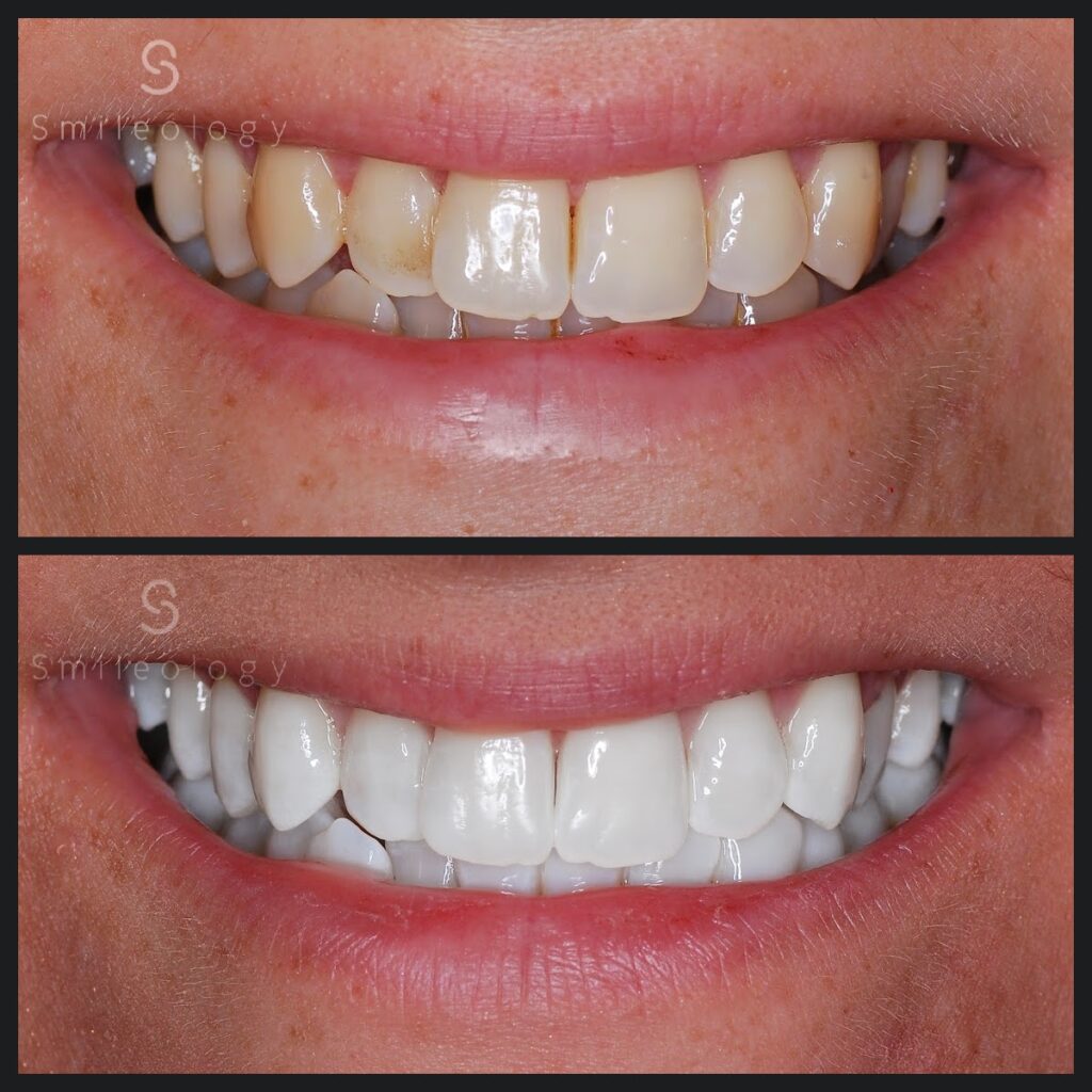 TW NA Whitening