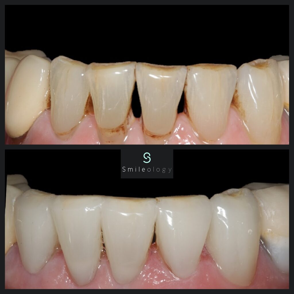 Edge Bonding (1)
