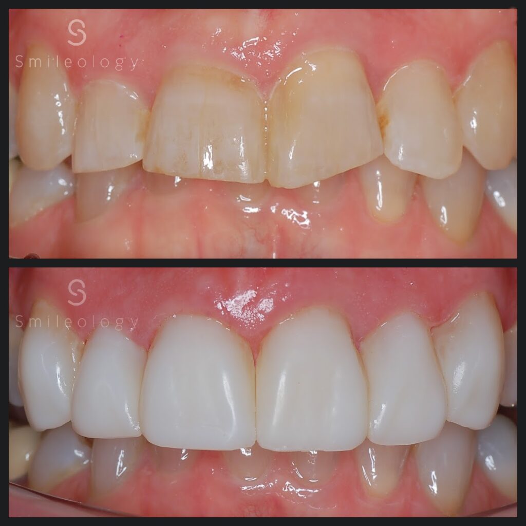 HP Smile fast B&A BDC