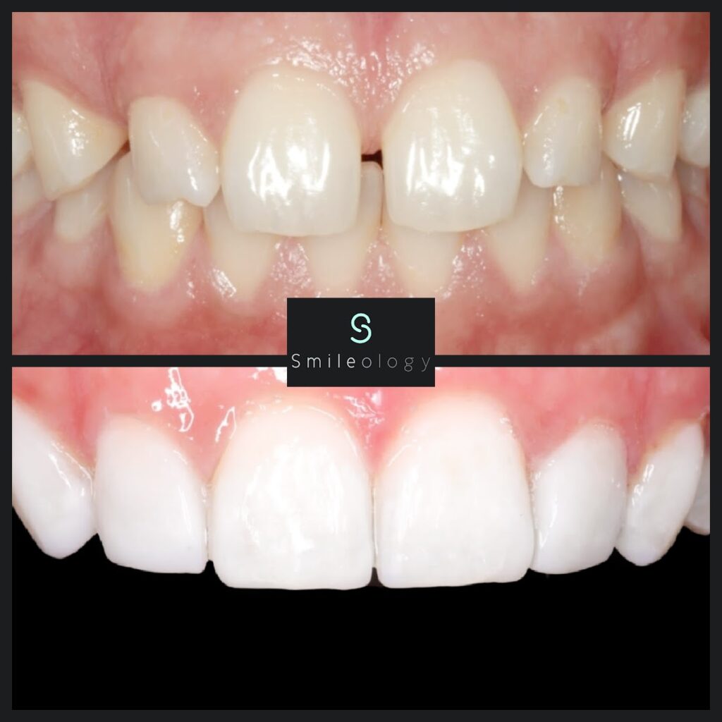 Suresmile and Composite bonding - Syed