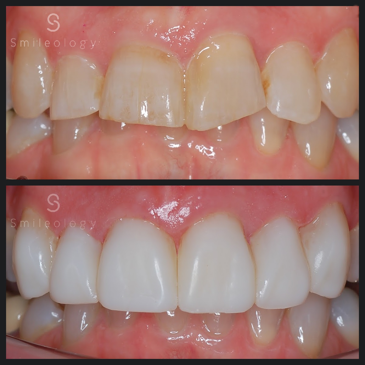 HP Smile fast B&A BDC