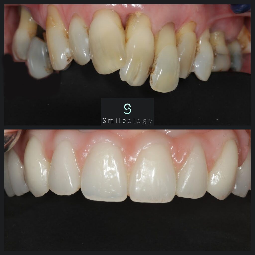 LC Overdenture