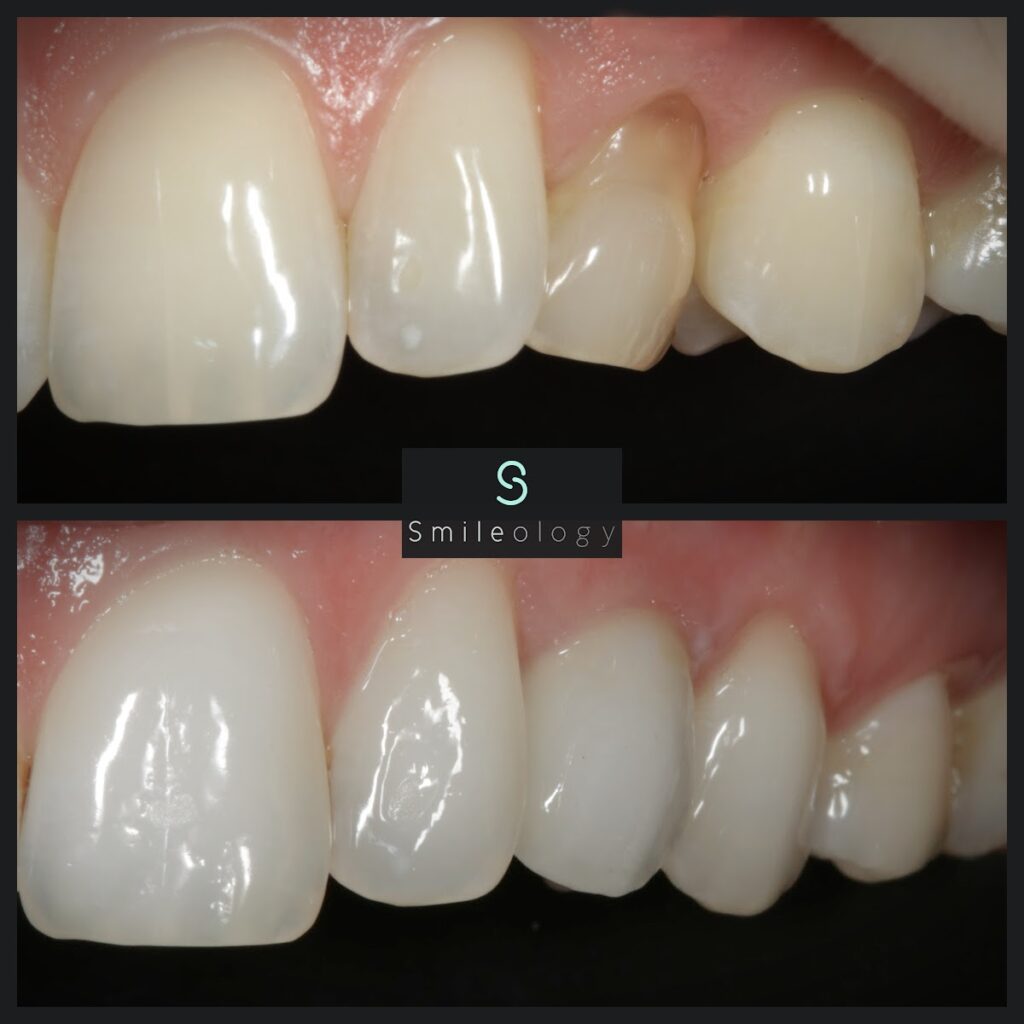 LL ULC Single Implant