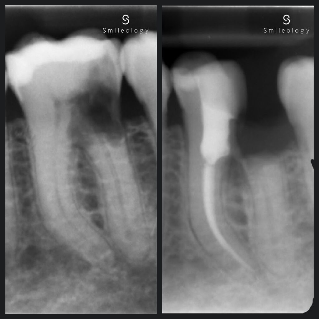 LLMolar1