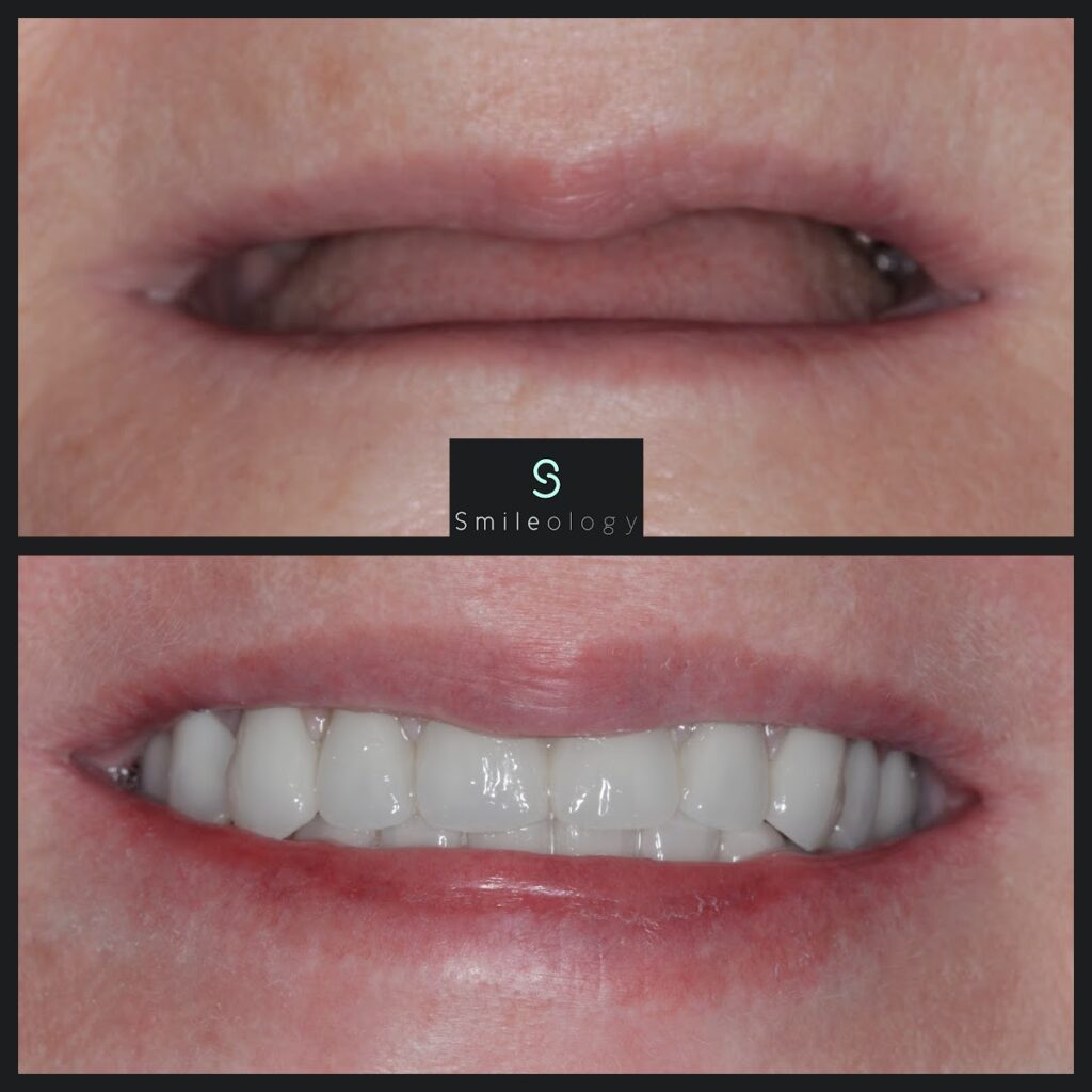 LW Overdenture