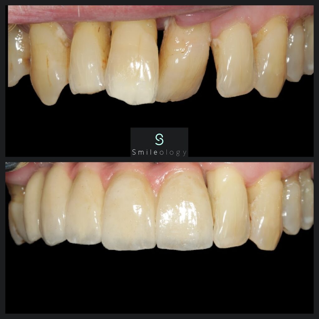 M Overdenture