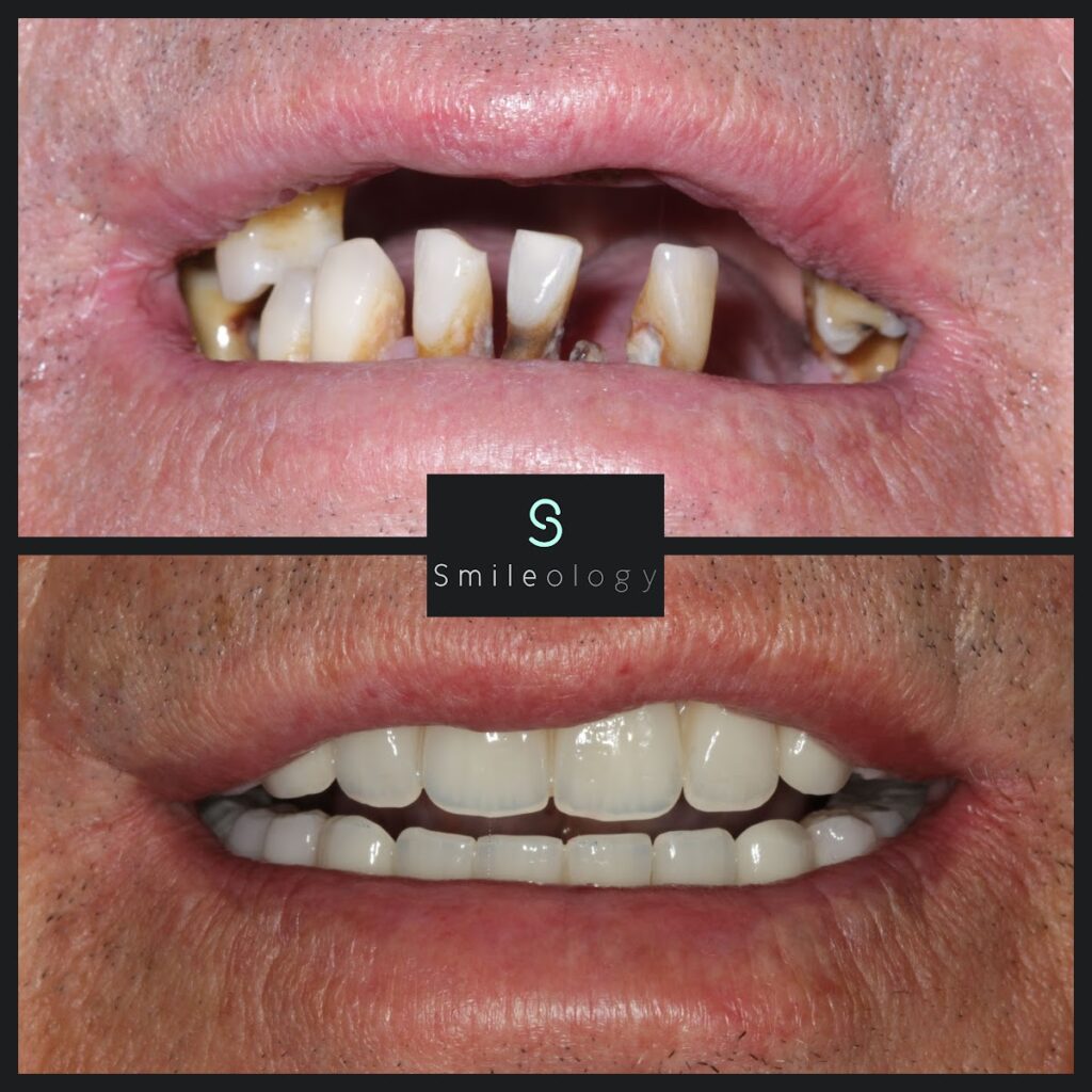 Overdenture 1