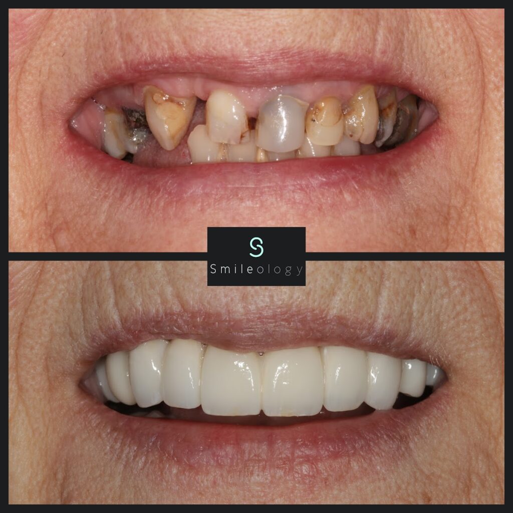 PE Overdenture