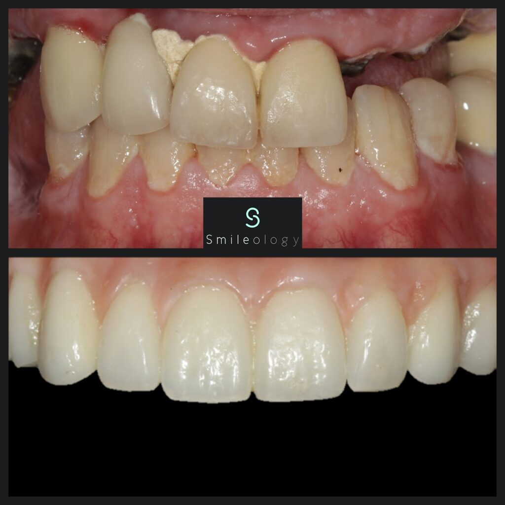 SC Overdenture