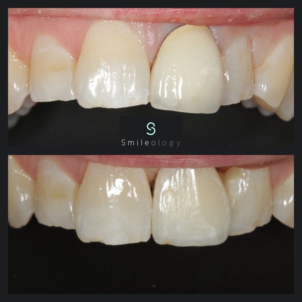 SM Single Implant