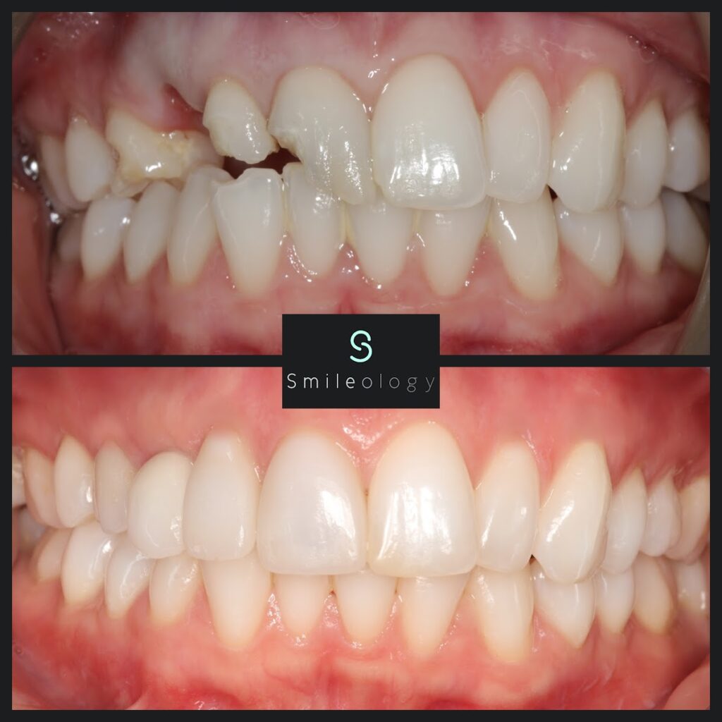 SW Single Implant