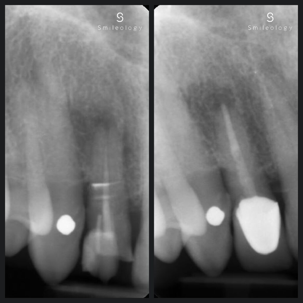 root canal dentist near me