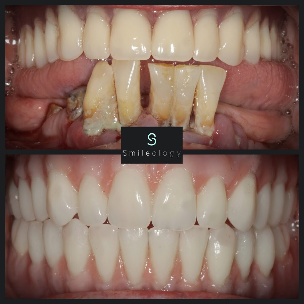 VG Overdenture