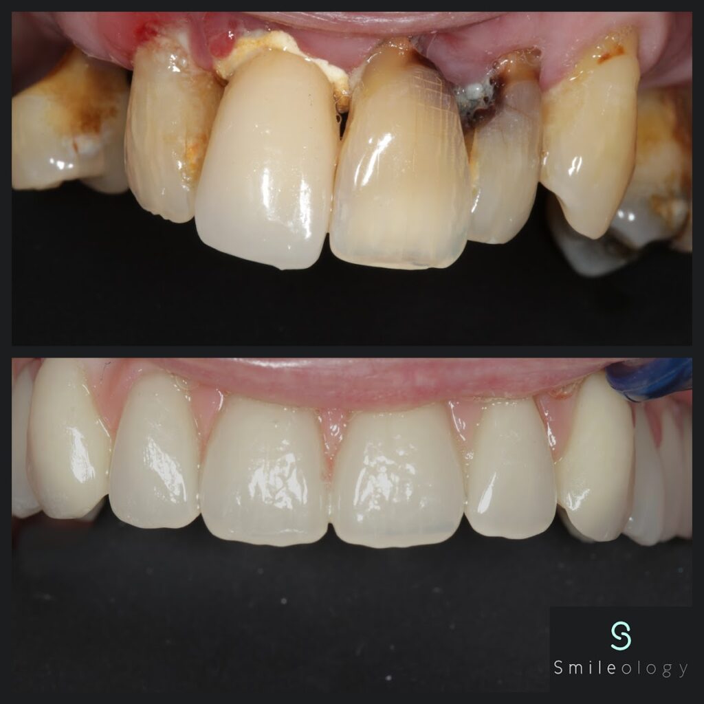 WB Multiple Implant