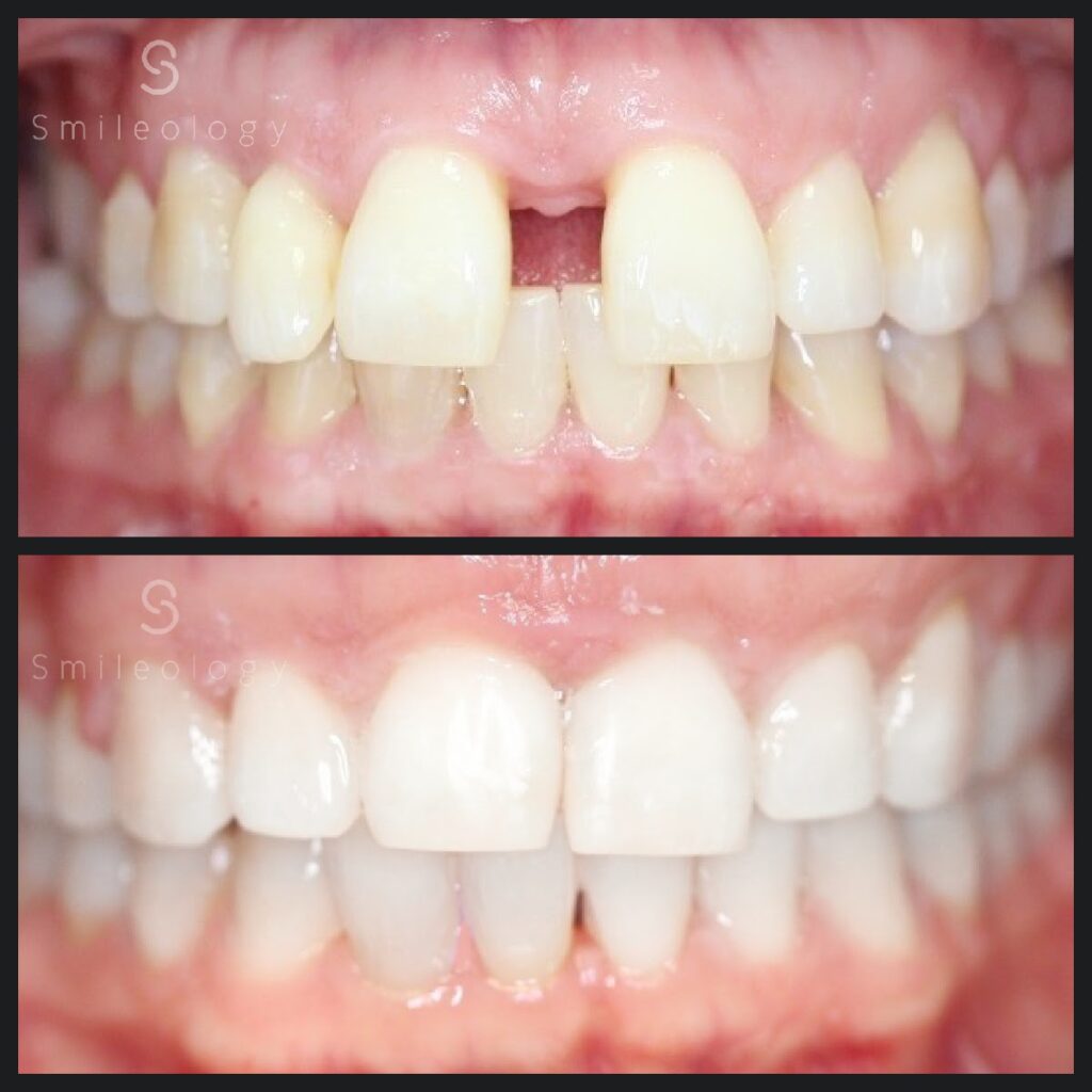 molly CEREC copy 2 1