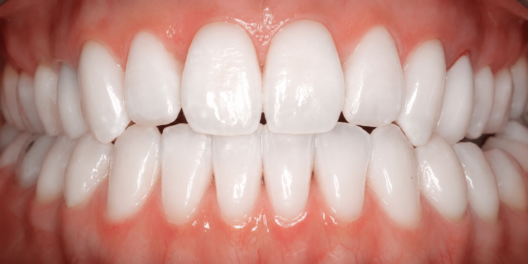 Invisalign Case 1 after