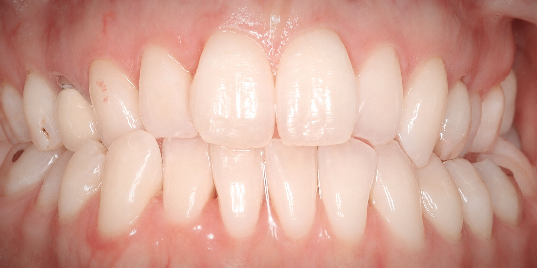 Invisalign Case 1 before