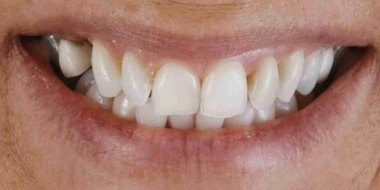 Invisalign Case 5 Before