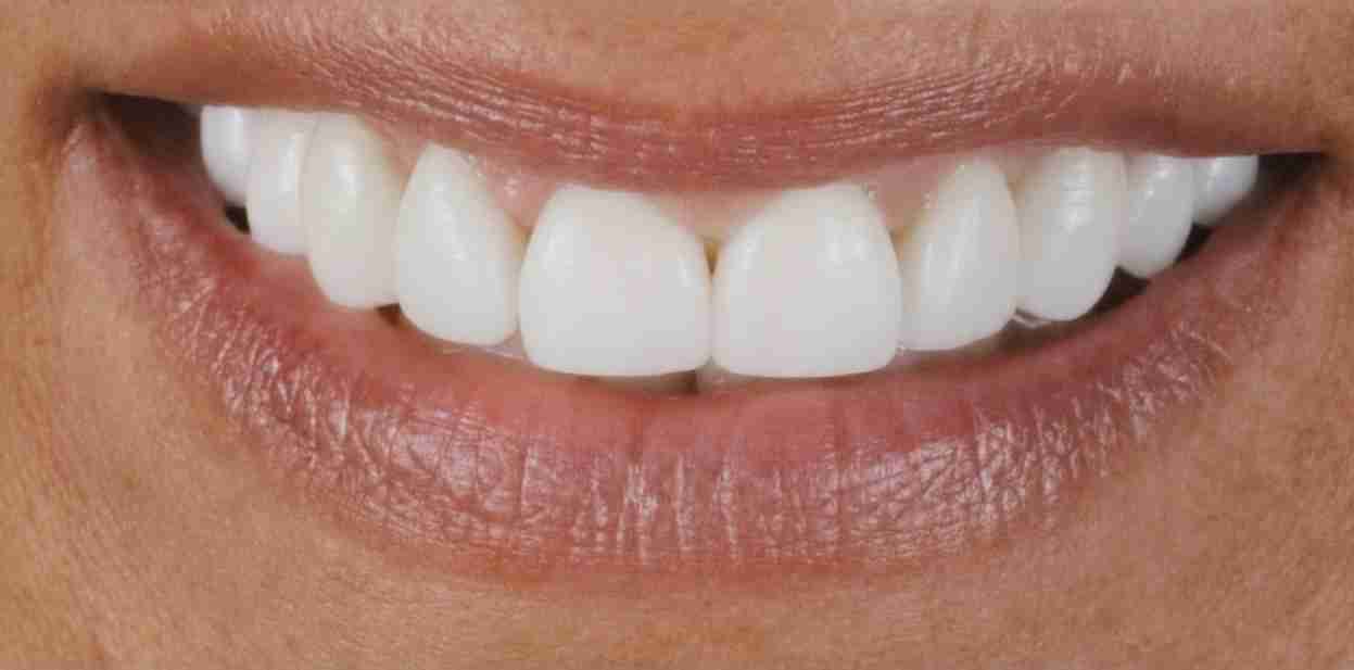 Invisalign Case 5 after
