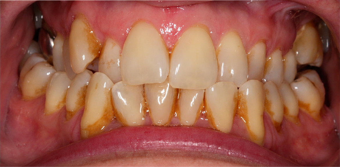 Invisalign case 3 before