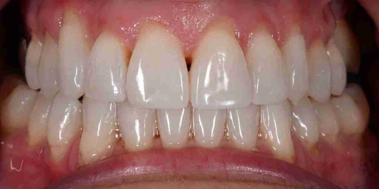 Invisalign case 4 After