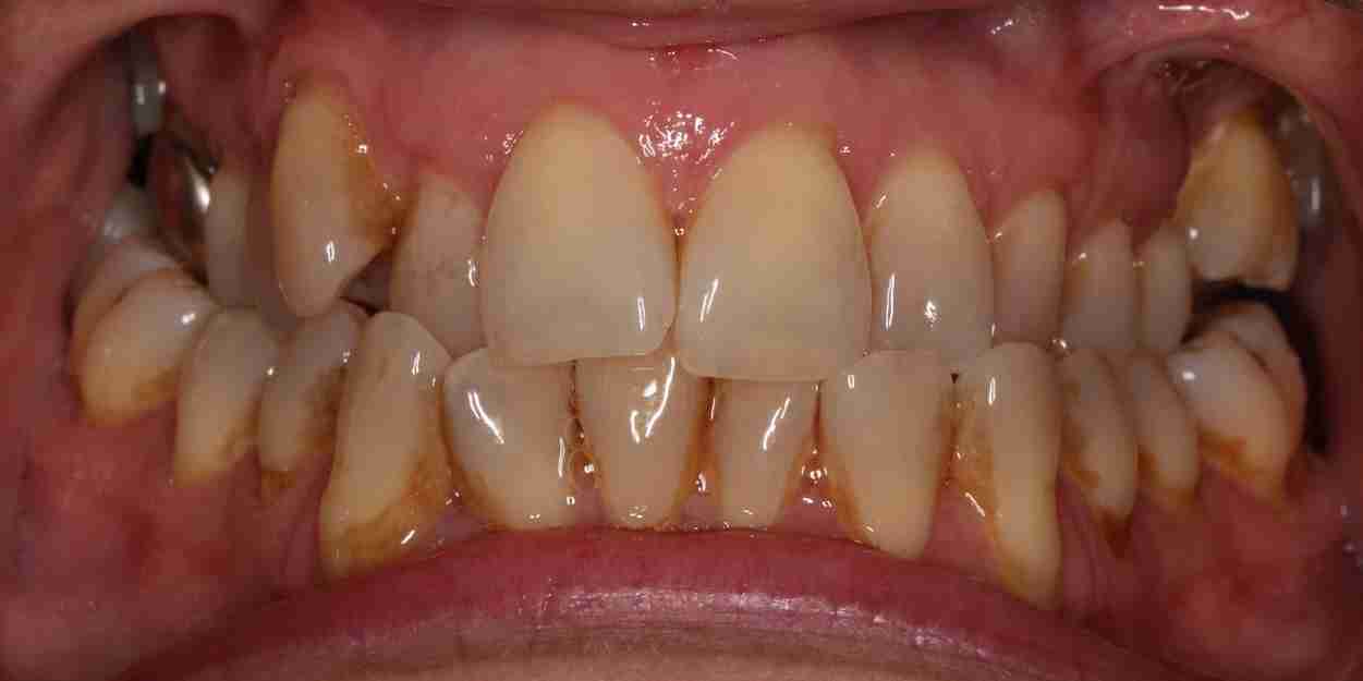 Invisalign case 4 Before